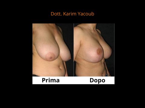  ptosi mammaria prima e dopo